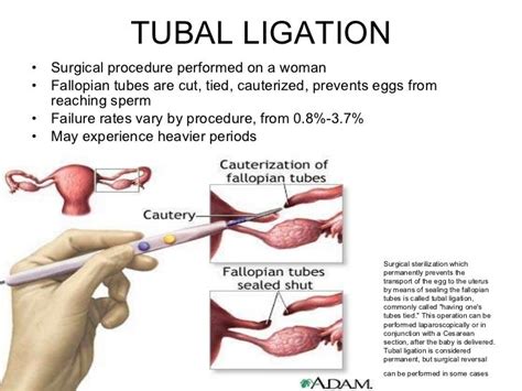 sex tubes|Tubal ligation